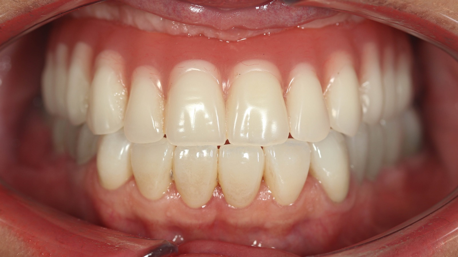 Before - From Removable Dentures to a Permanent Smile: A Life-Changing Journey