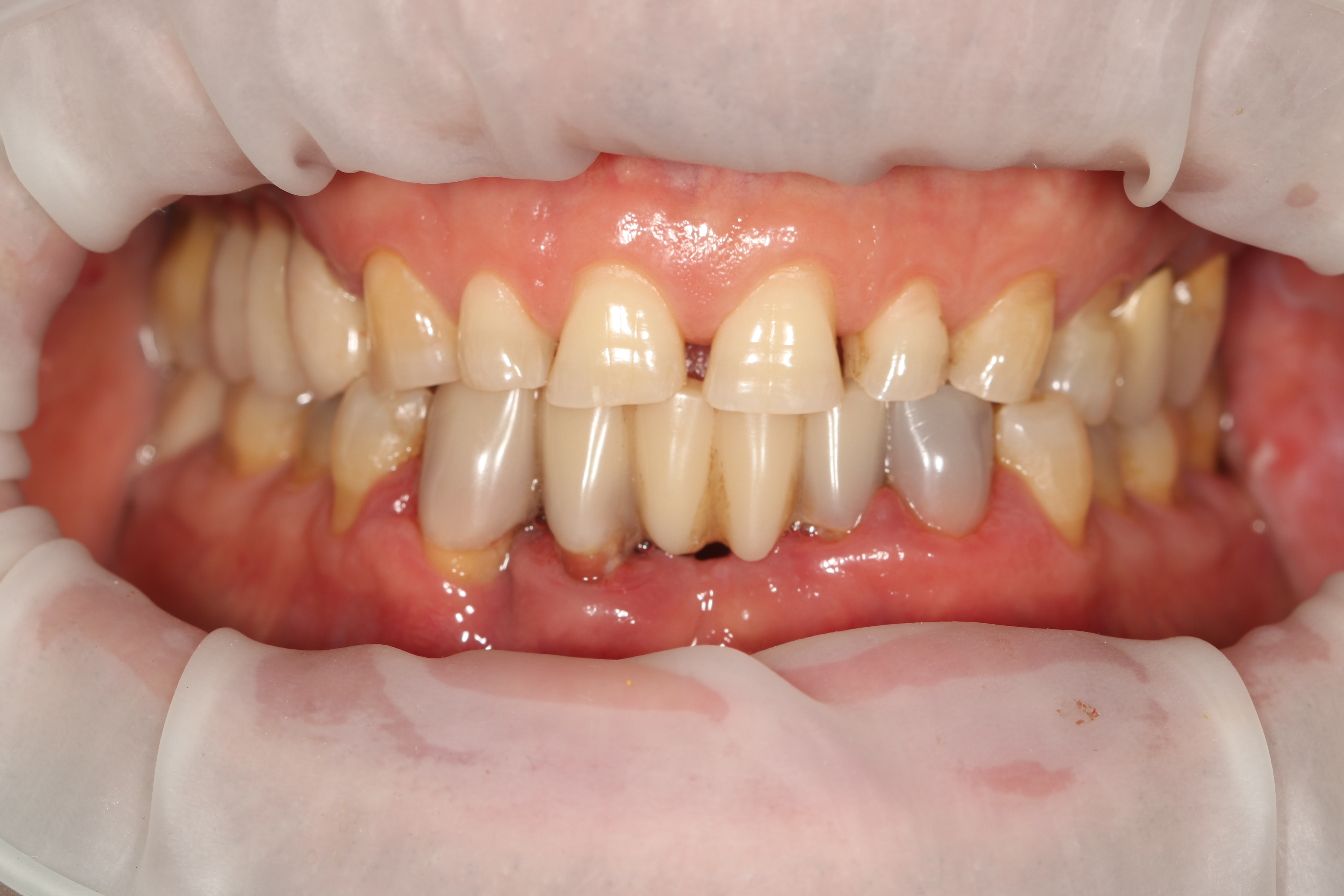Before - Rebuilding Function and Confidence After Advanced Periodontal Damage
