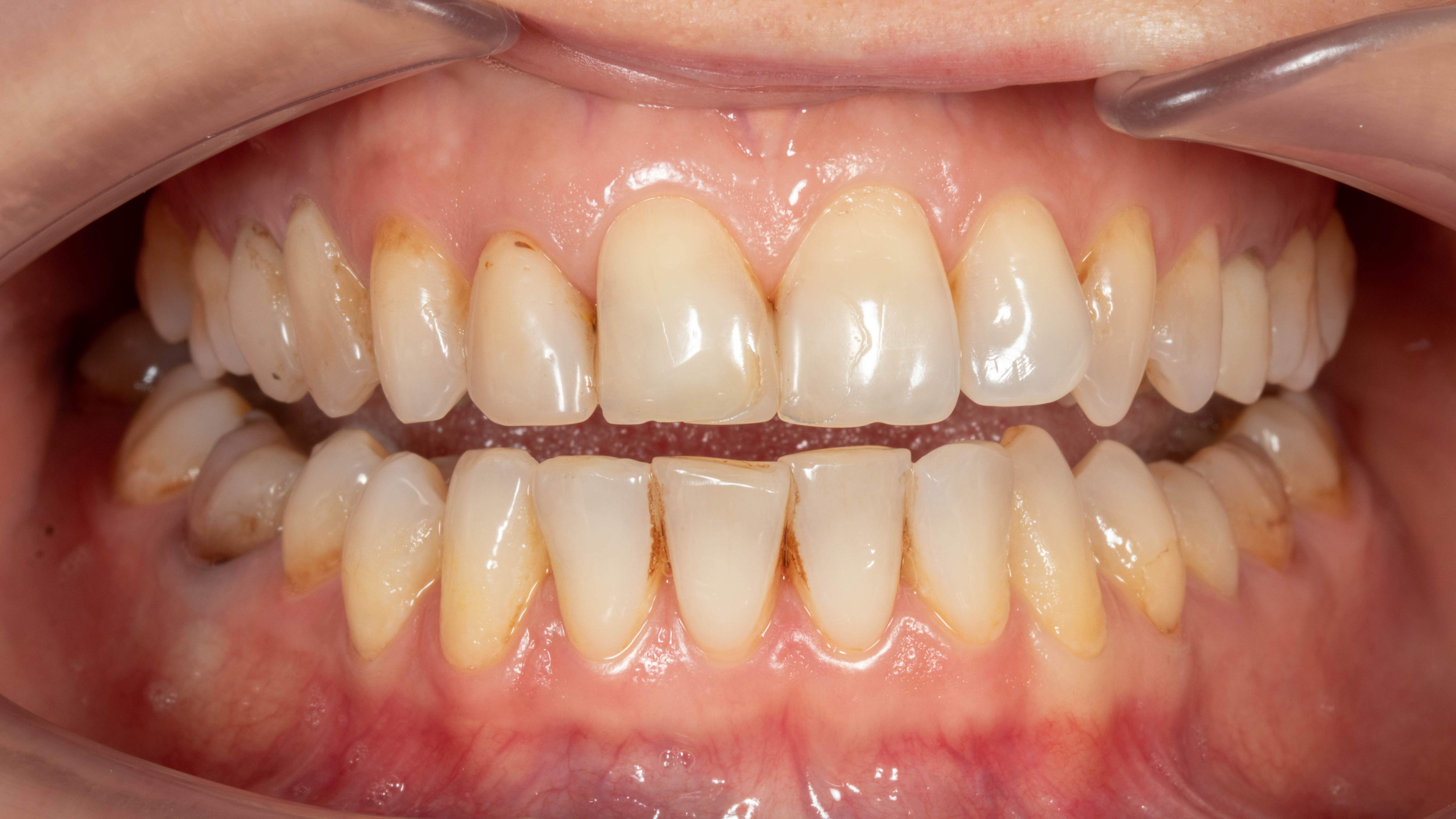 Before - Revitalizing a Worn Smile with Full Ceramic Rehabilitation