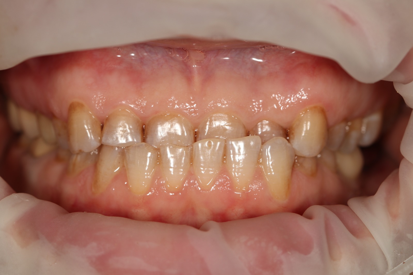 Before - The Rediscovery of a Smile: Overcoming a Lifetime of Wear