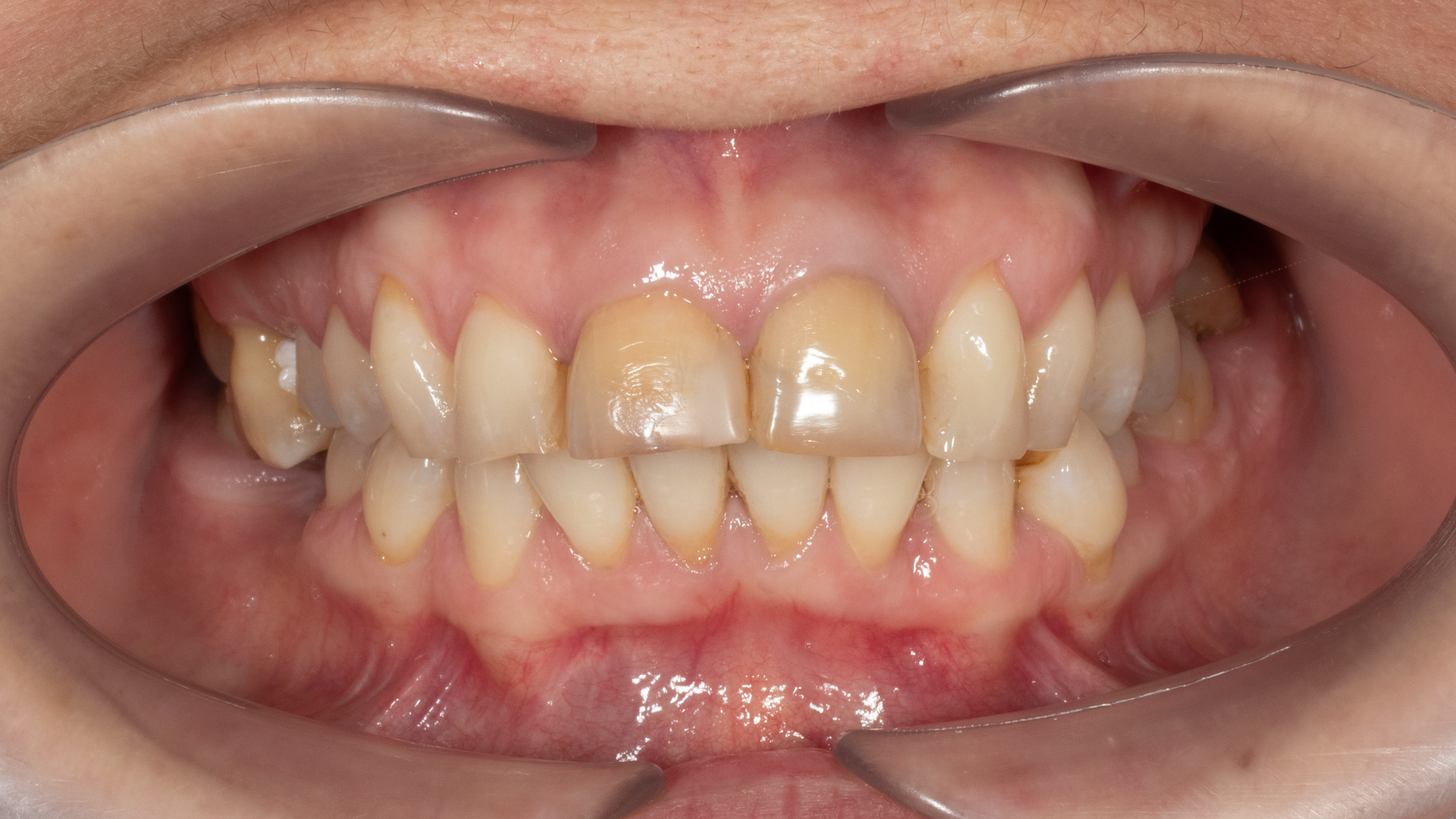 Before - Complete Smile Restoration with Ceramic Crowns