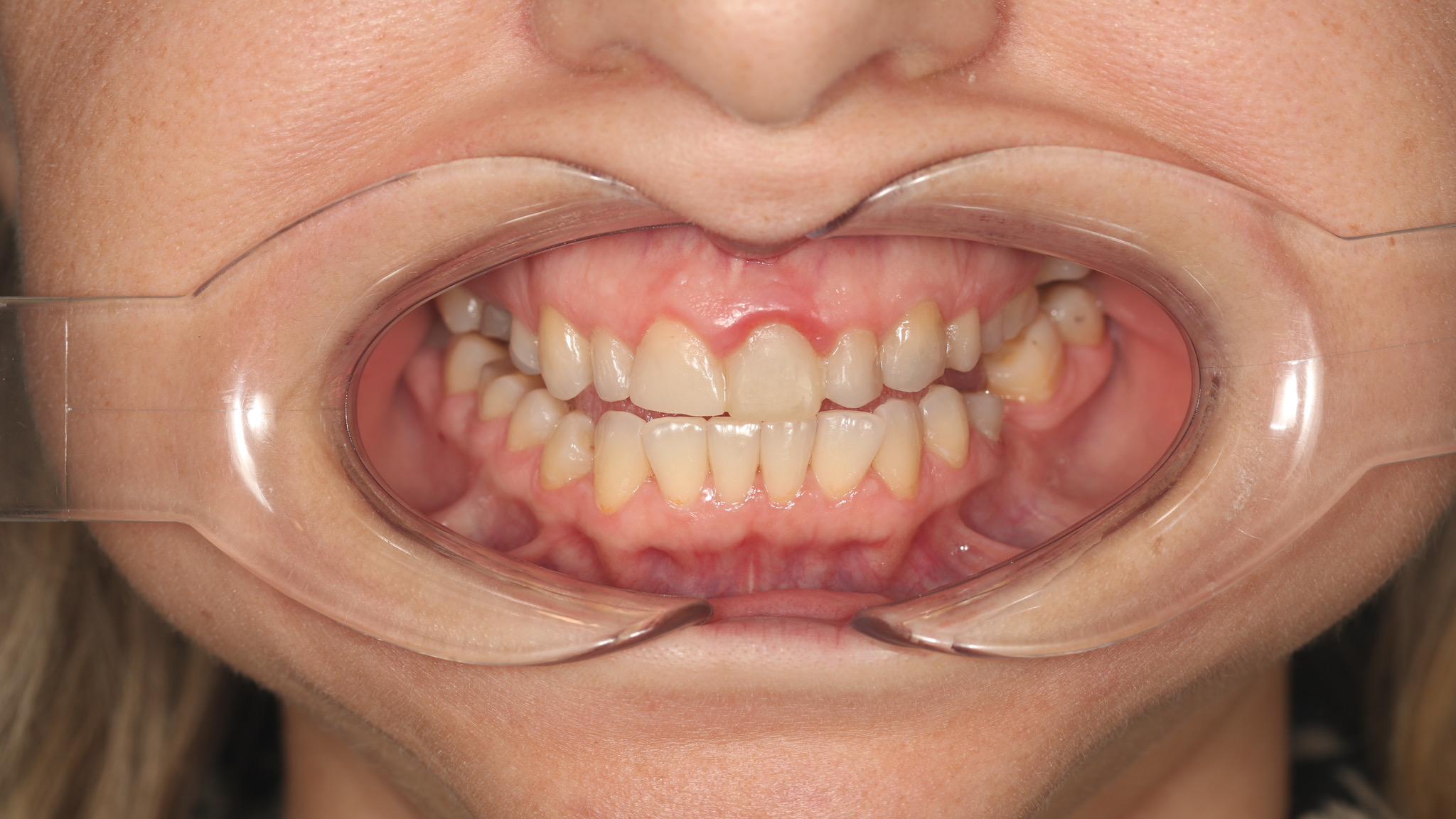 Before - From Crowding and Discoloration to a Radiant Veneer Smile